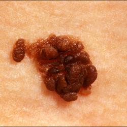Example of moleRemoval